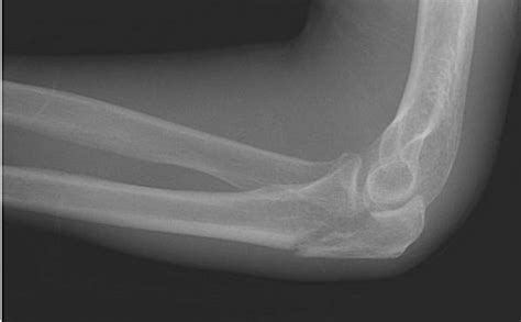 Olecranon Olecranon Fracture Wikipedia This Notch Is Called The