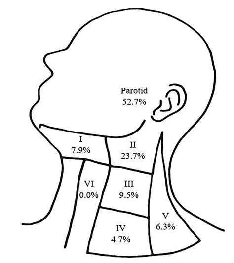 Pattern Of Metastatic Spread To Parotid And Cervical Lymph Node Basins