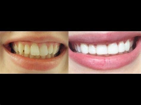 Contouring can fix issues such as sharp edges the internet is full of online videos and tutorials to get straight teeth at home. How to get INSTANT STRAIGHT teeth without braces, Veneers ...