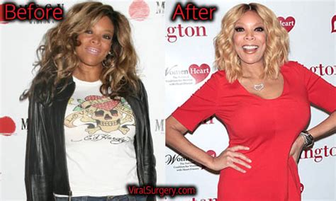Wendy Williams Plastic Surgery Before And After Liposuction Pictures
