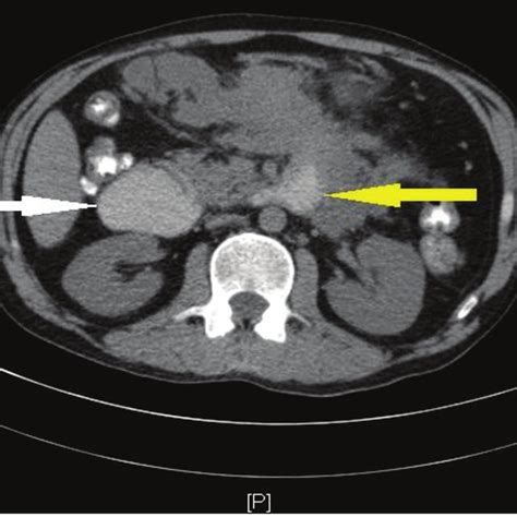 Ct Of Abdomen Transverse Section Showing Severely Dilated Proximal
