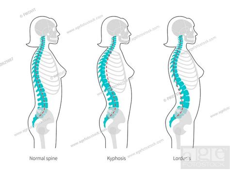 Woman Spinal Deformity Flat Vector Illustration Kyphosis Lordosis Of