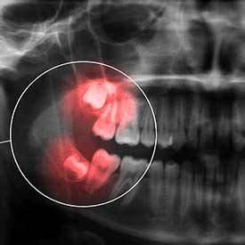 Wisdom tooth extraction is generally considered safe, but there are risks and potential complications. SE Calgary Wisdom Teeth Extraction | Walden Family Dental ...