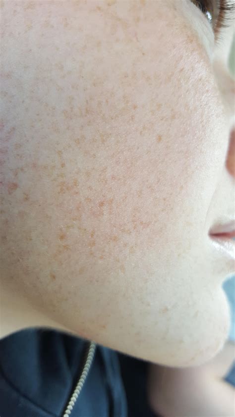 Skin Concerns Ive Had Bumps On Face For A While Sometimes Dry And