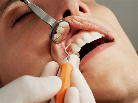 Zahnfleischerkrankungen Ursachen Symptome Und L Sungen Dutch Bullion