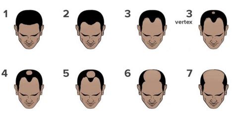 The Norwood Scale 7 Stages Of Hair Loss The Bald Company