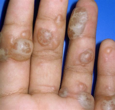 What Causes Blisters On Palms Of Hands
