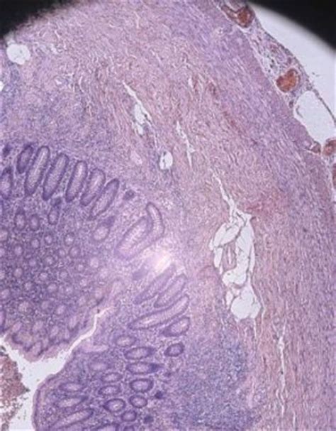 Abnormal vaginal bleeding is the most common symptom of womb cancer. Symptoms of Uterine Cancer