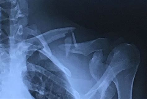 How To Deal With A Clavicle Fracture Broken Collarbone