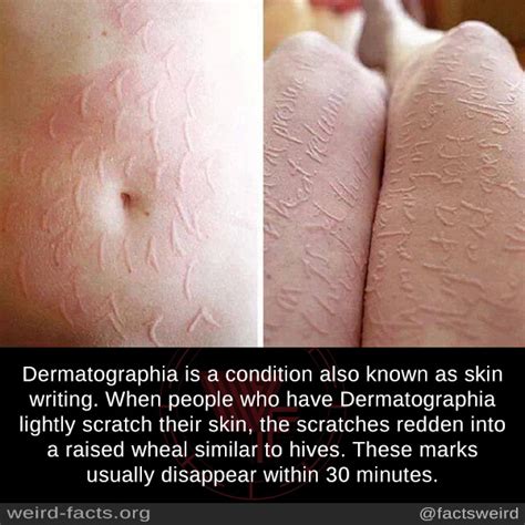 Dermatographia On Tumblr