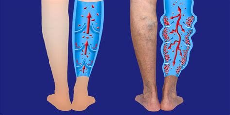 Lower Leg Pain And Swelling Causes And Treatment Pristyn Care