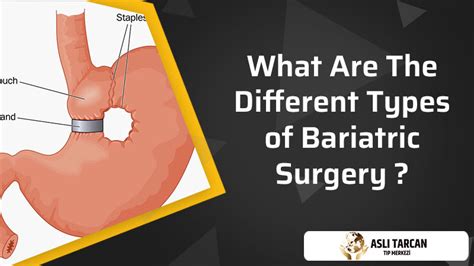 What Are The Different Types Of Bariatric Surgery Asli Tarcan Clinic