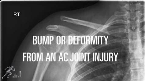 Can Surgery Fix A Bump Or Deformity Of Your Shoulder Youtube