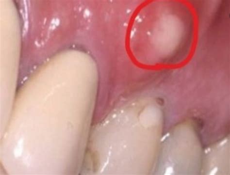 Dental Abscess Infection Tooth Abscess Infection Gum Abscess The Best Porn Website