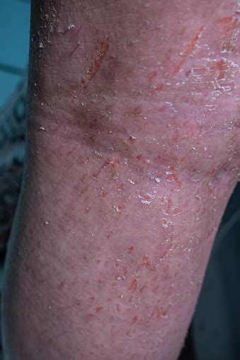 Back Of The Knee And Leg Of A Young Woman Who Has Atopic Dermatitis