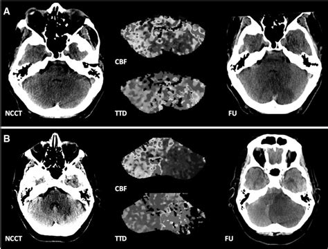 Early Imaging Prediction Of Malignant Cerebellar Edema Development In