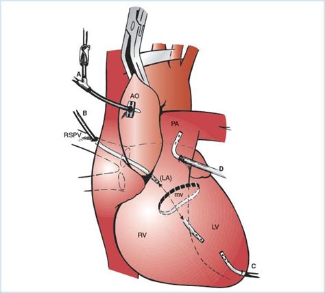 Cardiopulmonary Bypass Equipment Circuits And Pathophysiology