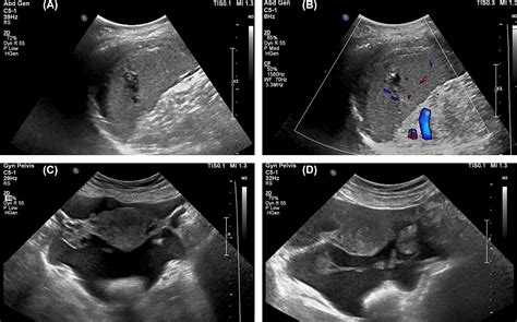 Atraumatic Spontaneous Splenic Rupture In A Female Covid 19 Patient