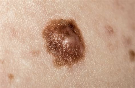 Pictures Of Cancerous Moles Early Stage Cancerous Moles Images