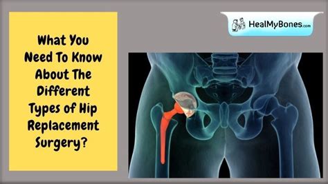 What You Need To Know About The Different Types Of Hip Replacement