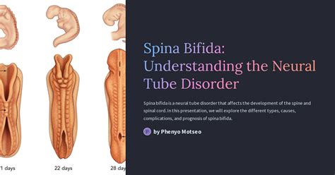 Spina Bifida Understanding The Neural Tube Disorder