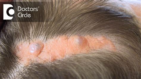 Infected Sebaceous Cyst In Scalp
