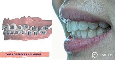 The Ultimate Guide Of 12 Different Types Of Braces And Clear Aligners