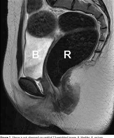 Figure 4 From Mri In The Diagnosis Of Mayer Rokitansky Kuster Hauser