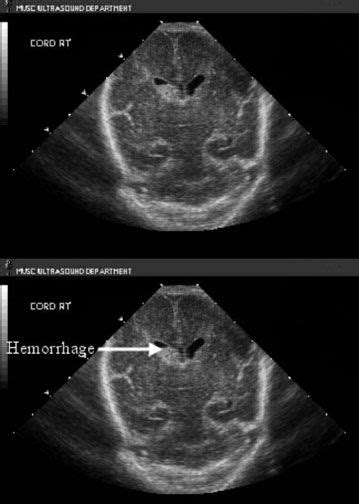 Intraventricular Hemorrhage Ultrasound Obstetric Ultrasound