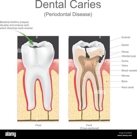 Dental Caries Cross Section