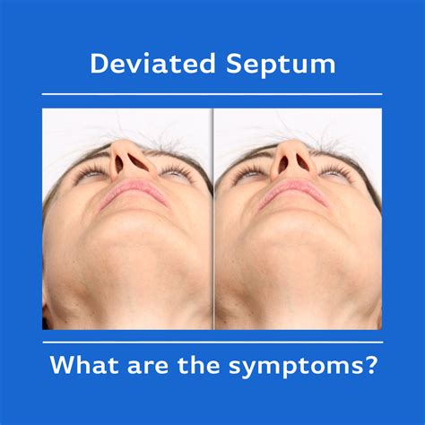 Deviated Septum — Ent And Allergy Inc