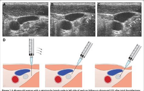 Figure 1 From Ultrasound Guided Fine Needle Aspiration For Retrojugular