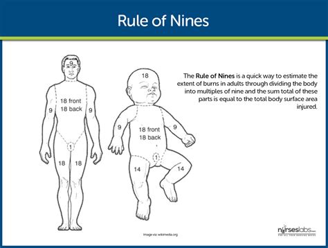 Burn Rule Of Nines Chart