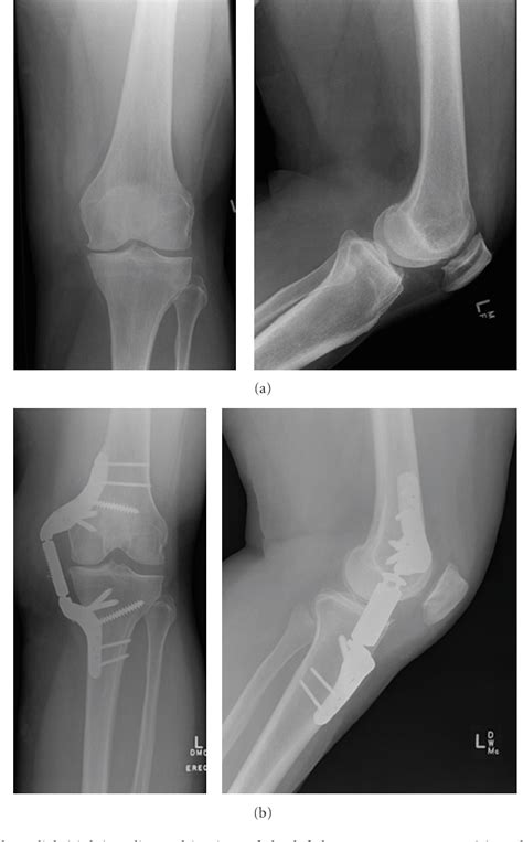 Figure 3 From Knee Osteoarthritis Treatment With The Kinespring Knee
