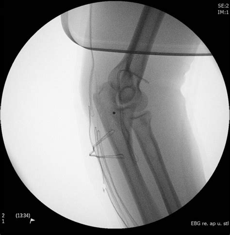 Traumatic Rupture Of The Distal Triceps Tendon A Series Of 7 Cases