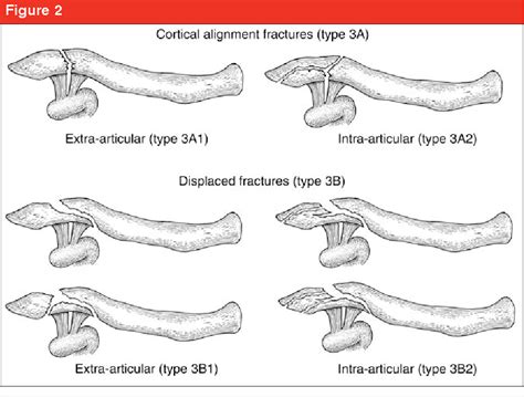 Figure 2 From Management Of Distal Clavicle Fractures Semantic Scholar