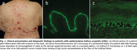 Epidermolysis Bullosa Acquisita Immunofluorescence