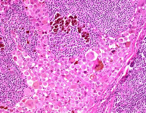 Lymph Node Metastasis In Melanoma Light Micrograph Stock Image