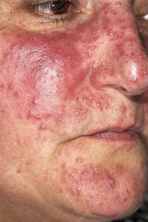 Acne Rosacea Stock Image C0470372 Science Photo Library
