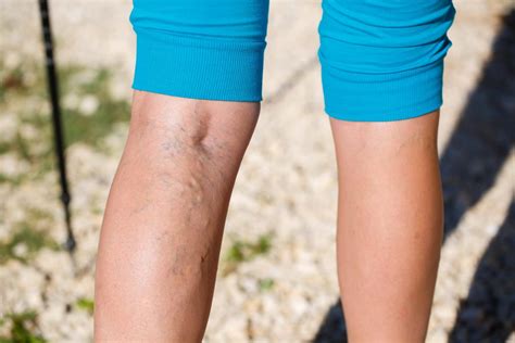 Broken And Spider Veins Causes Removal And Treatments Auckland Nz