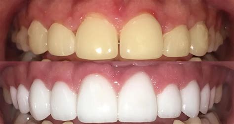 Pineview Dental Care Cosmetic Before And After In Morgantown
