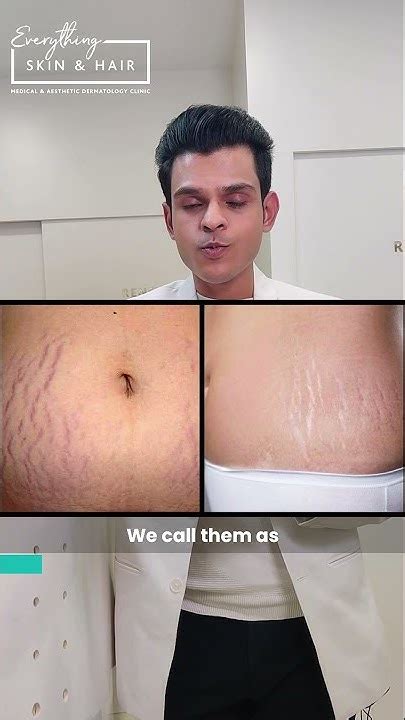 Types Of Stretch Marks Youtube