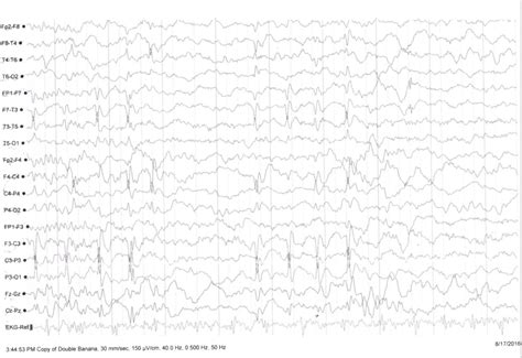Rolandic Epilepsy As A Heralding Manifestation Of Wilson Disease In A 6