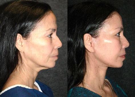 Dr Jacono Facelift Photos Before And After Facelift Info Prices