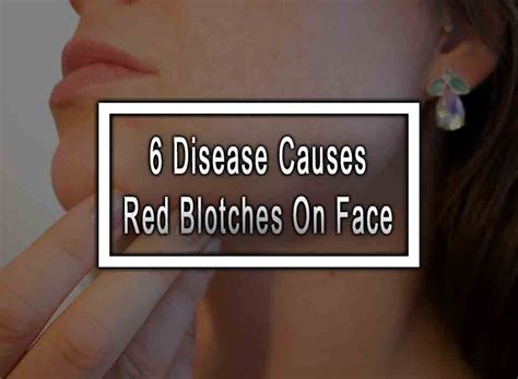 6 Disease Causes Red Blotches On Face