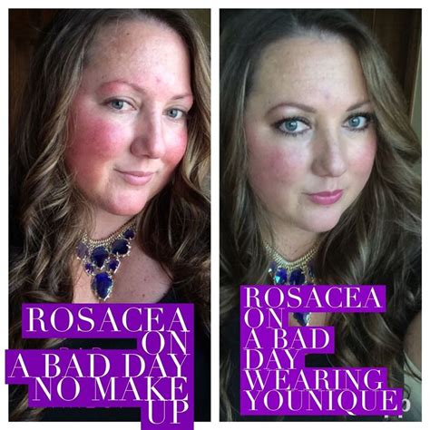 Rosacea Beforeafters Withwithout Make Up And Then Using Younique