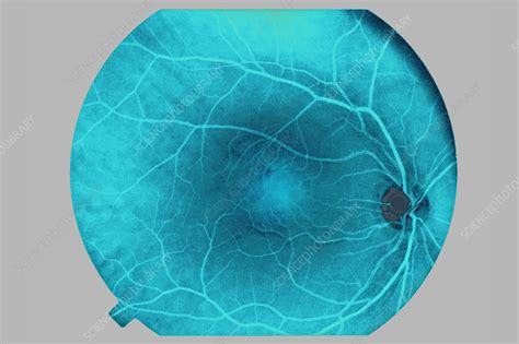 Fundus Of The Eye Stock Image C0365387 Science Photo Library
