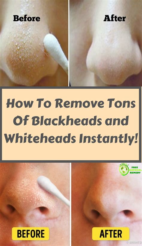 How To Remove Blackheads In Home Remedies Howotremvo