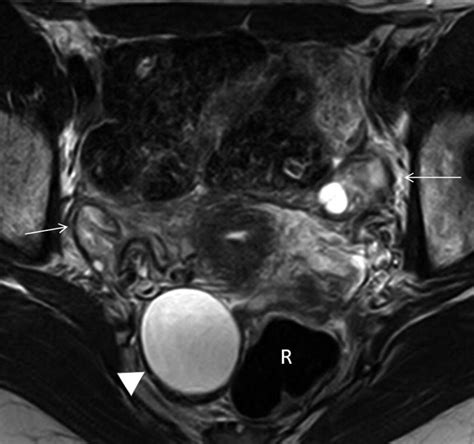 Adnexal Masses Benign Ovarian Lesions And Characterization SpringerLink