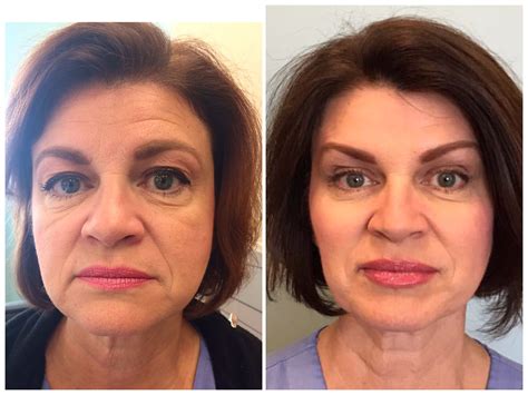 full facial rejuvenation with 6 syringes of juvederm by julia fox rn facial rejuvenation